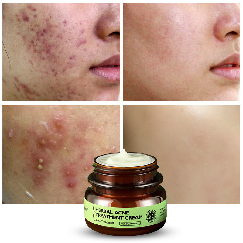 VIBRANT GLAMOUR Herbal Acne Cream 30g